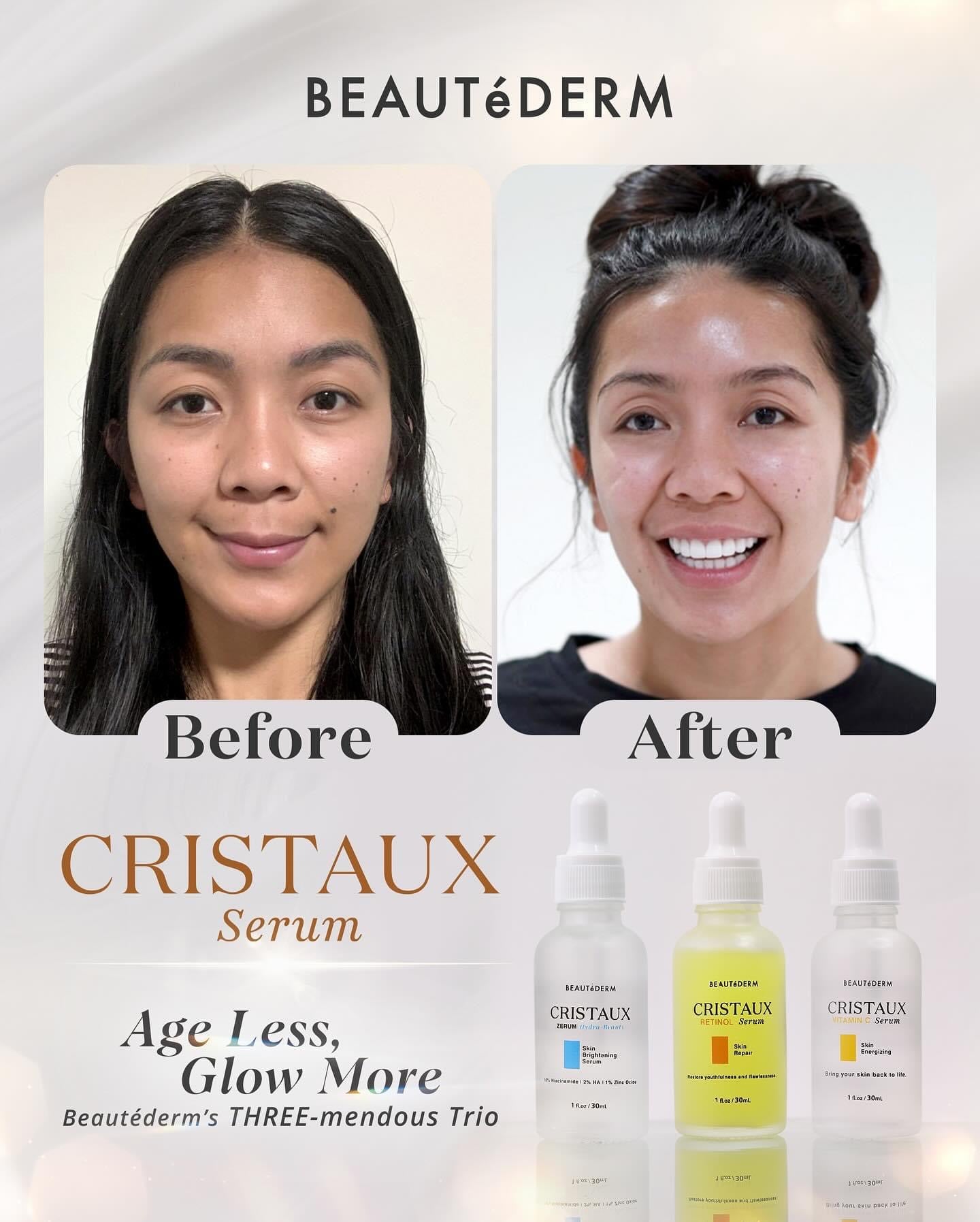 Cristaux Zerum Hydra-beauty 30ml before and after Testimonial